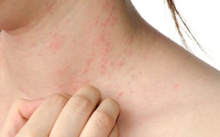 ചൂടുകുരു വേനല്‍ക്കാലത്ത് സ്വാഭാവികമാണ് ചൂടുകുരു ശമിക്കാന്‍ വീട്ടിലിരുന്നു ചെയ്യാവുന്ന ചില കാര്യങ്ങള്‍