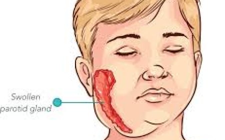 കുട്ടികളിലെ മുണ്ടിനീര്: ജാഗ്രത വേണമെന്ന് ആരോഗ്യവകുപ്പ്