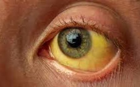 വേനൽച്ചൂട് കനത്തതോടെ സംസ്ഥാനത്ത് മഞ്ഞപ്പിത്തം പടരുന്നു;കരുതൽവേണം